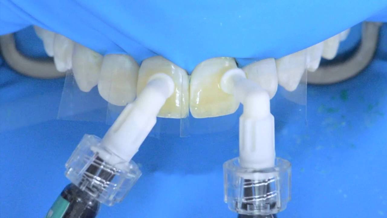 Fluorosis treatment using Icon infiltration, step by step