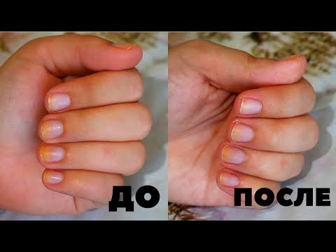 Уберёт ли СОДА желтый пигмент на ногтях / как отбелить ногти