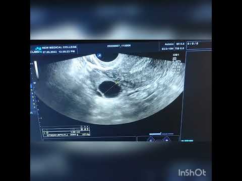 cyst in ovary(simple cyst in ovary on trans vaginal scan)#shorts #youtubeshorts #medical