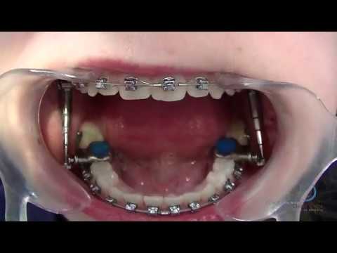 Advansync - Aparelho Funcional