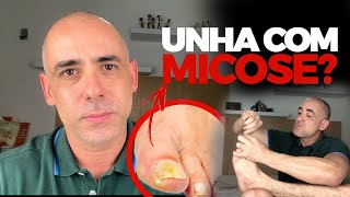FUNGO? MICOSE DE UNHA? CHEGA DISSO! | Dr Dayan Siebra