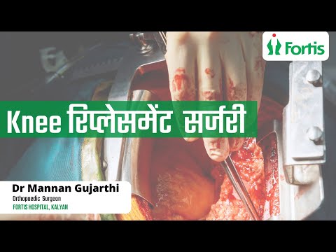 Knee Replacement Surgery | Knee Pain Dr. Manan Gujarathi
