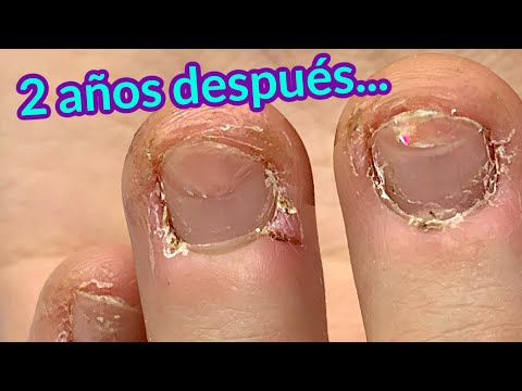 Transformación de UÑAS MORDIDAS - ¡2 AÑOS después! RETOQUE de UÑAS para Anna