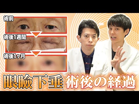 眼瞼下垂手術の解説動画