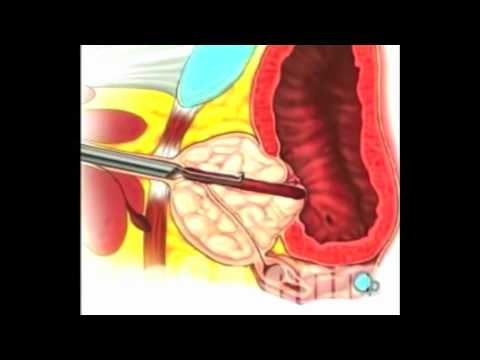 Prostata metodo di trattamento del cancro di soda Trattamento della prostata video di adenoma