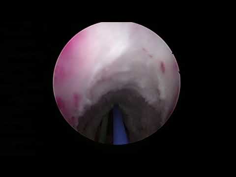 Urethral Stricture Treatment with the Holmium Laser/Лазерная внутренняя оптическая уретротомия/ВОУТ