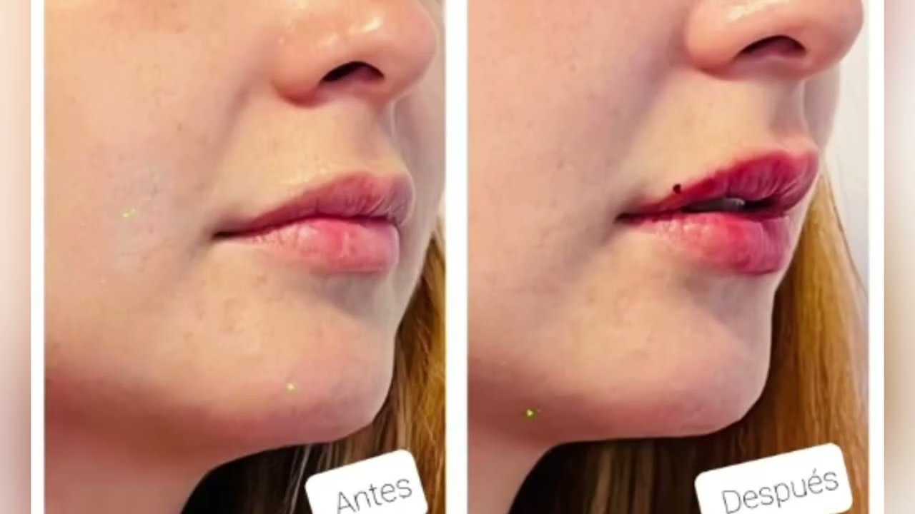 Ácido Hialurónico para relleno en labios