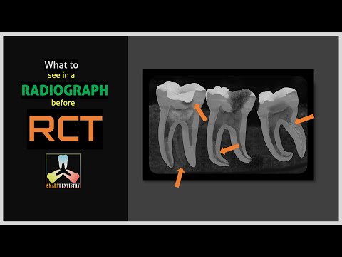 Na co zwrócić uwagę na zdjęciu RTG przed leczeniem endodontycznym?