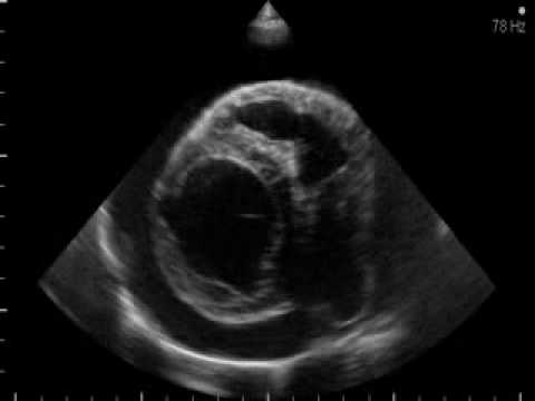 Fiziotenzom Behandlung von Hypertonie Fallgeschichten von Hypertonie