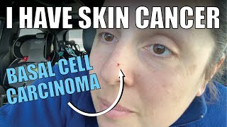 I HAVE SKIN CANCER  Basal Cell Carcinoma  signs wh