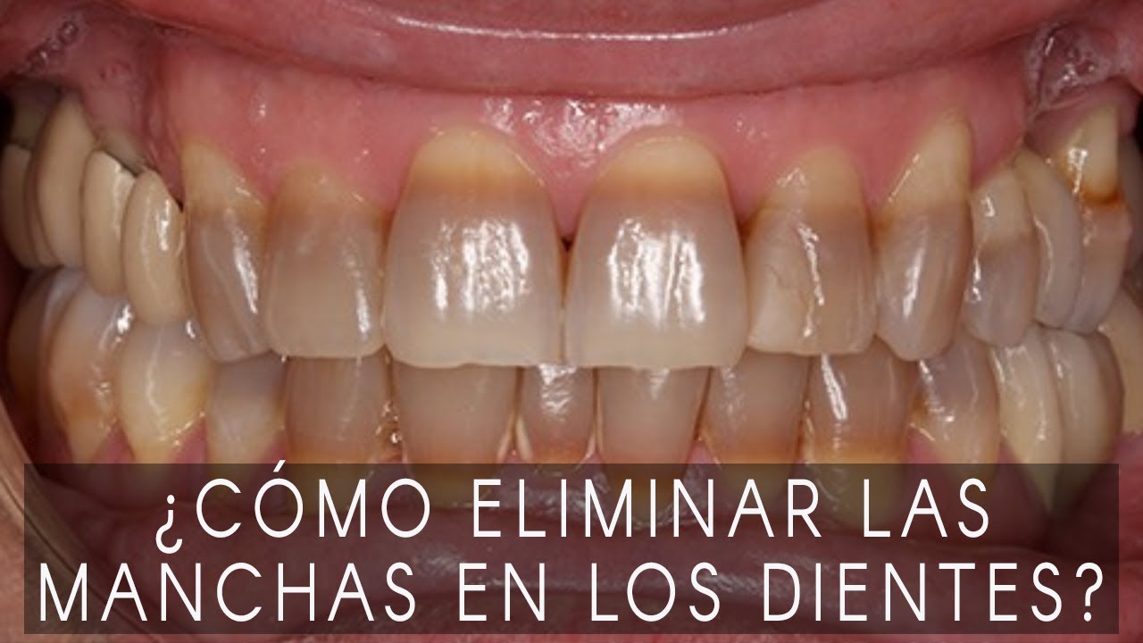 Manchas en los dientes: ¿cómo eliminar las manchas blancas y marrones