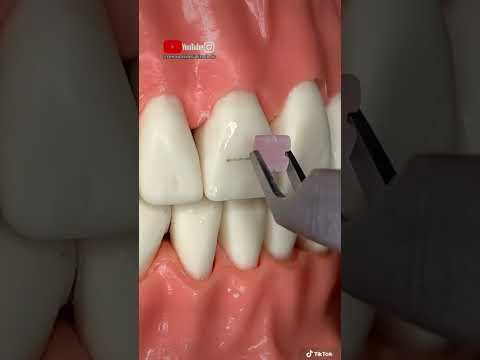 ¡Proceso completo para instalar BRACKETS ESTÉTICOS!