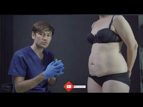 Abdominoplastika — Dr. Choriyev #1