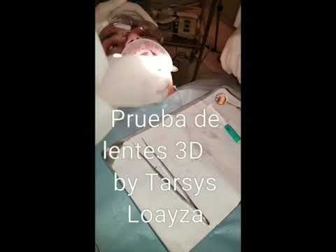 Carillas dentales en Cartagena, Colombia - Dra. Tarsy Loayza - Dental Veneers