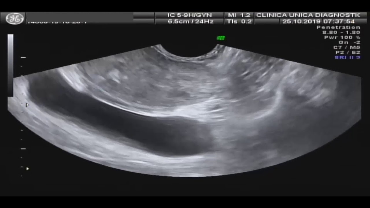 BIÓPSIA DE PRÓSTATA