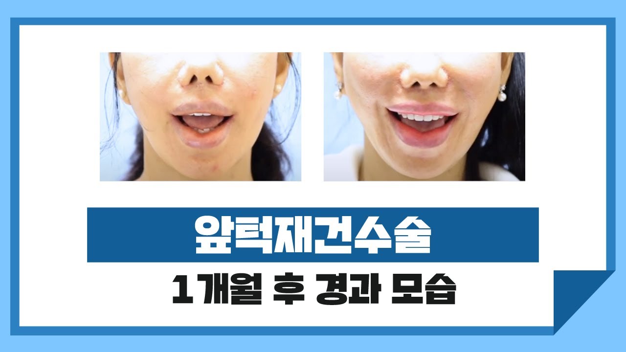 앞턱 재건 수술 (Mentalis Resuspension) 썸네일