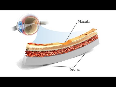 La Degeneración Macular Asociada a la Edad (DMAE): ANIMACIÓN