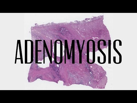 26. Adenomyosis