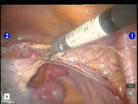 Benign Ovarian Tumor - Robotic Adnexectomy