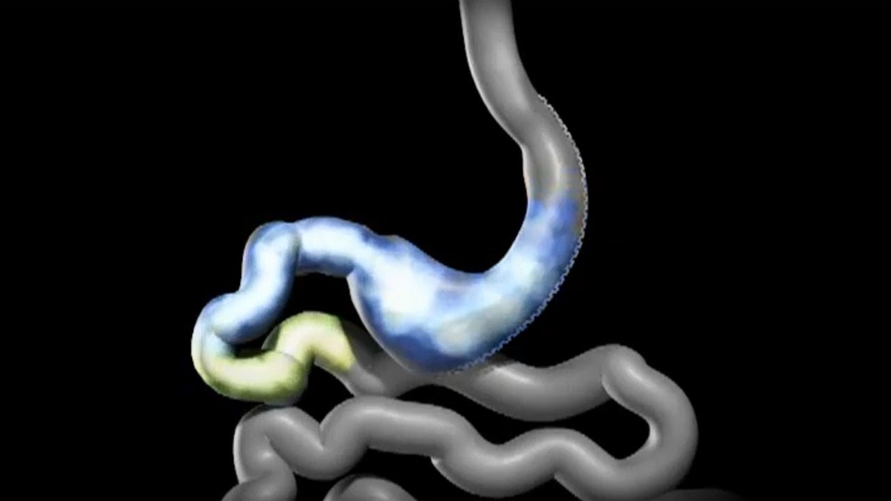 What Vegetables to Eat After Gastric Bypass CedarsSinai