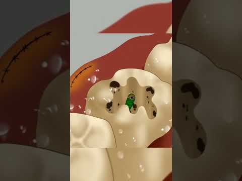 ASMR | Removal of insect from teeth asmr video #viral #shorts #asmr