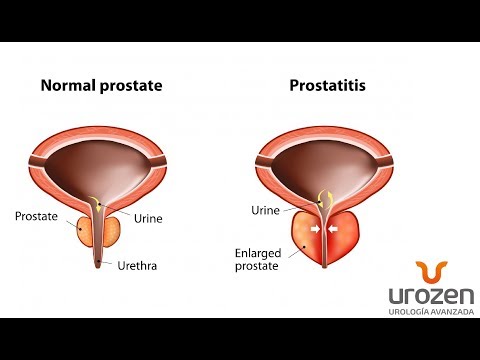 A scrotum pirossága prosztatitis