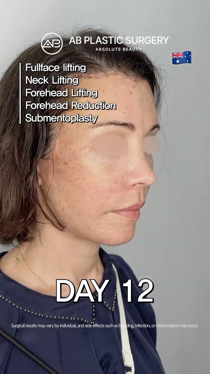 Looking Years Younger After a Facelift & Fat Grafting
