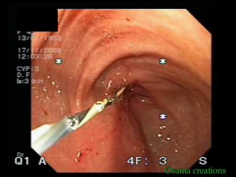 Malignant Stenosis And Stent Implantation After Billroth I