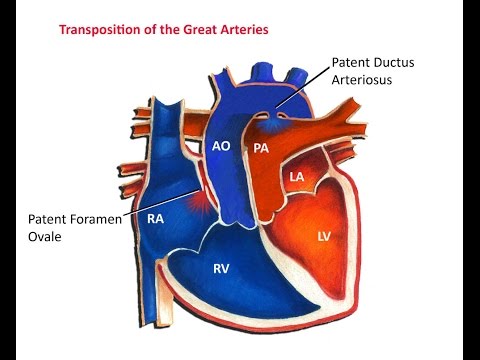 Transposition of the Great Arteries