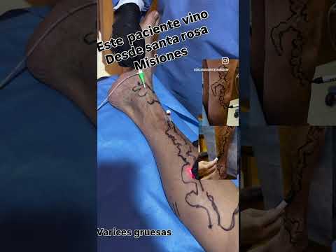 Centro paraguayo de varices paciente vino desde santa rosa misiones