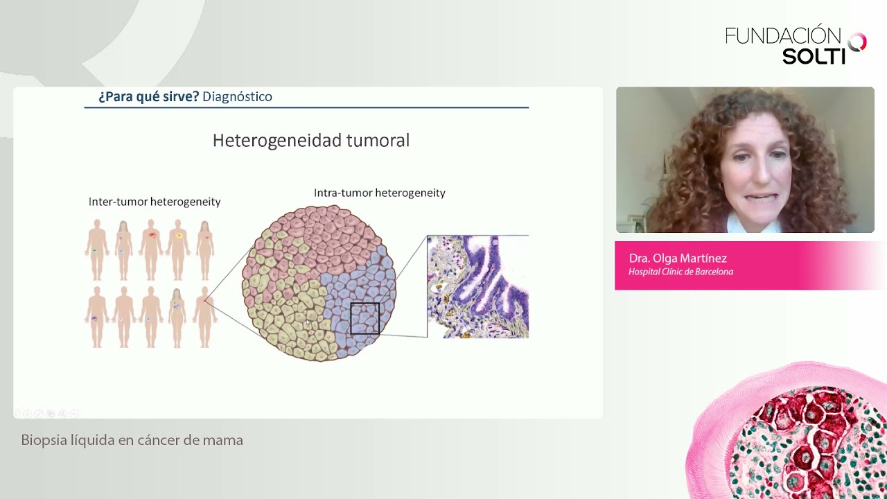 Biopsia líquida en cáncer de mama