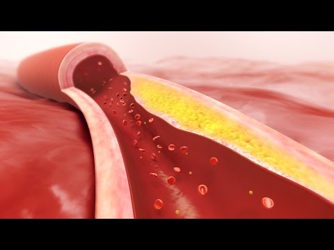 Eine Herzensangelegenheit - Akutes Koronarsyndrom