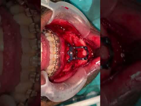 Redo Genioplasty - Revision Chin Job