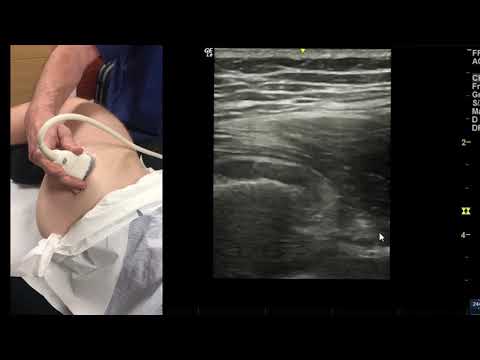 Ultrasound examination of the lateral hip