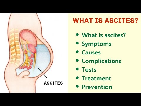 What is Ascites? |Symptoms|Causes|Complications|Tests|Treatment|Prevention|Precaution|Medical coding