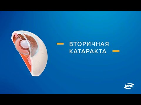 Вторичная катаракта - лечение самыми эффективными методами лазерной хирургии в Москве
