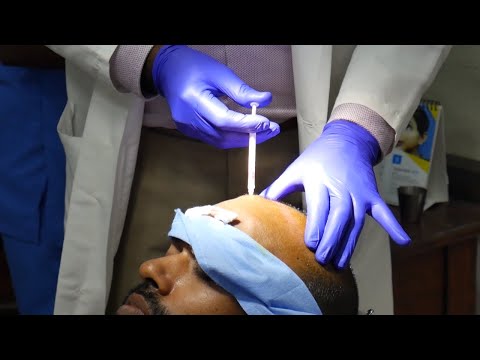 Platelet-rich Plasma Therapy For Hair Growth