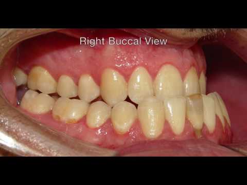 Orthodontic Treatment of Sever Skeletal Class III - Mohammad