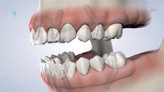 What Is Full-Arch Restoration in Oklahoma City, OK | Oral Surgery Specialists of Oklahoma