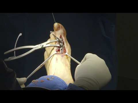 Dureri nervoase sciatice înțepate în articulația genunchiului