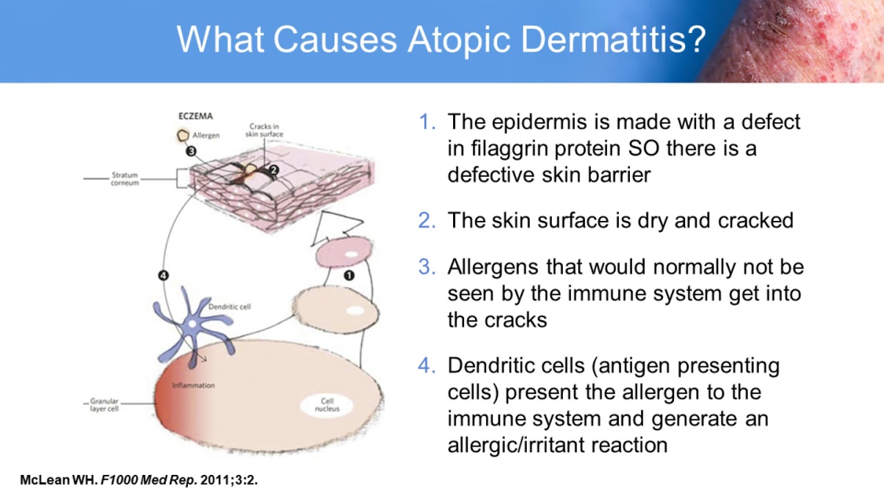 Atopic Dermatitis: Improving Outcomes in Adult and Pediatric Patients