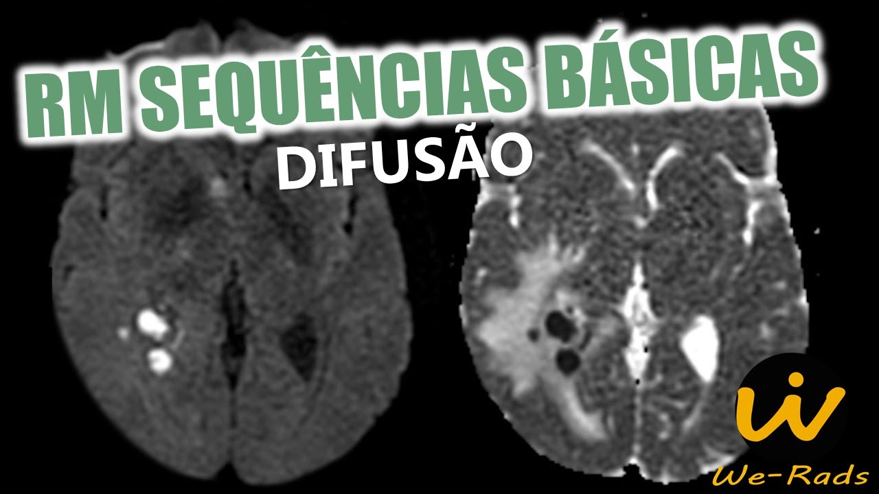 Sequência de Difusão na Ressonância Magnética