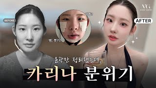 필터 안 써도 Ai 같은 얼굴형!? 윤곽수술로 완성💎