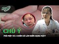 Phù Mặt Và 2 Chân Là Bệnh Gì Biểu Hiện Nguyên Nhân Biến Chứng Và Cách Điều T