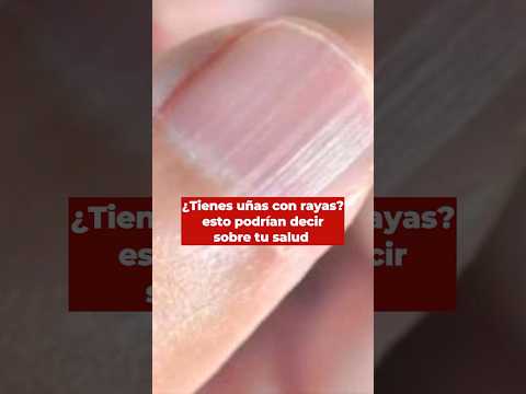 ¿Tienes uñas con rayas? Conoce qué podría decir sobre tu salud y qué significan #noticiasmilenio