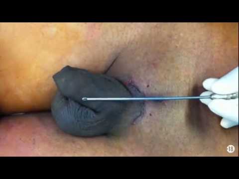 Penoplastie bibimensionnelle par le Dr Jacques Derhy