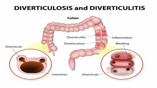 You Won't Believe What Happens Inside Your Colon #viral