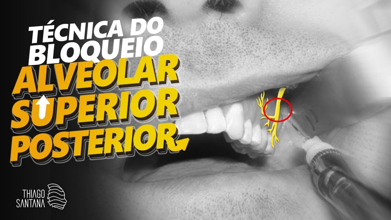 Anestesia por bloqueio do nervo alveolar superior posterior