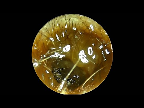 Earwax From Hell 32.0🔥