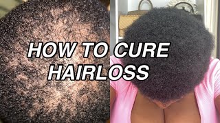 HOW TO CURE HAIR LOSS FAST - ALOPECIA, EDGES, MALE PATTERN BALDNESS